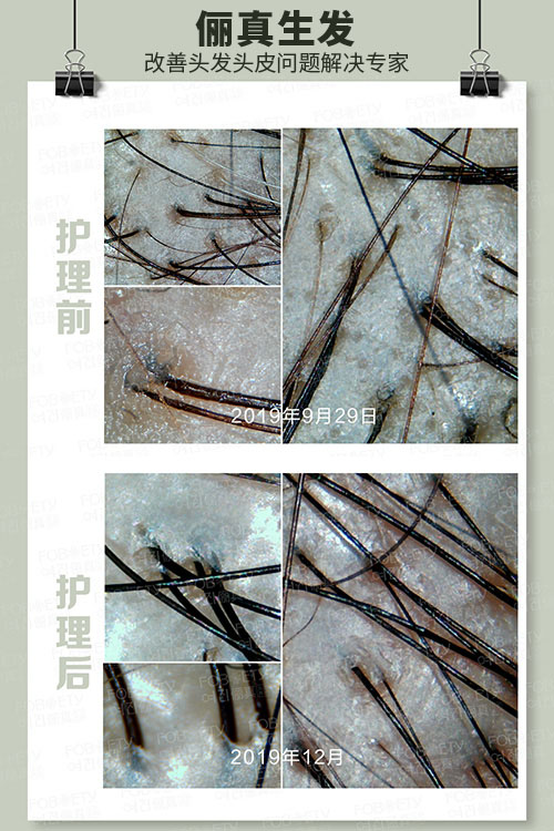 頭油、頭癢