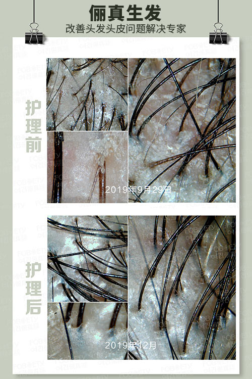 頭油、頭癢